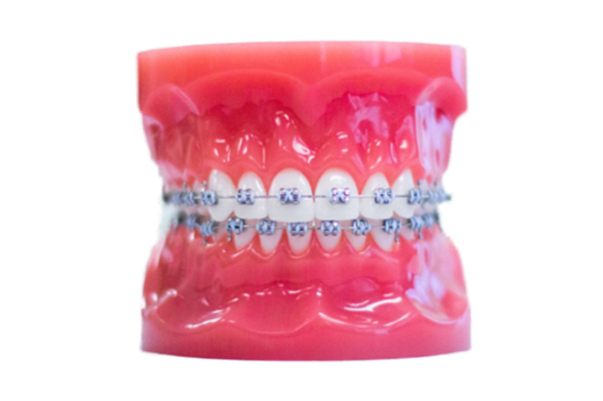 metal braces image