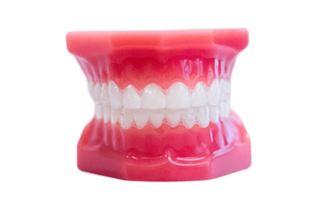 Braces Treatment